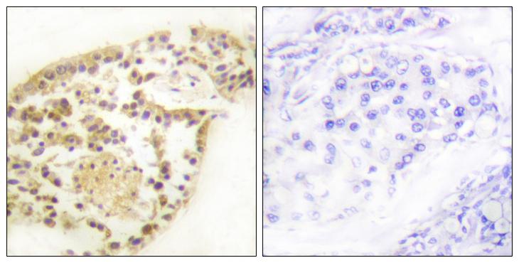 Vimentin Antibody - P-peptide - + Immunohistochemistry analysis of paraffin-embedded human breast carcinoma tissue using Vimentin (Phospho-Ser83) antibody.