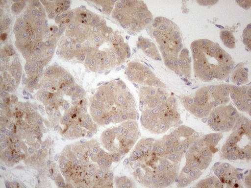 VIP Antibody - Immunohistochemical staining of paraffin-embedded Carcinoma of Human liver tissue using anti-VIP mouse monoclonal antibody. (Heat-induced epitope retrieval by 1mM EDTA in 10mM Tris buffer. (pH8.5) at 120°C for 3 min. (1:150)