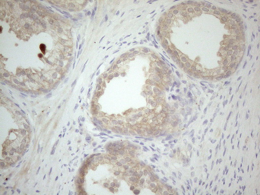 VIP Antibody - Immunohistochemical staining of paraffin-embedded Carcinoma of Human prostate tissue using anti-VIP mouse monoclonal antibody. (Heat-induced epitope retrieval by 1mM EDTA in 10mM Tris buffer. (pH8.5) at 120°C for 3 min. (1:150)