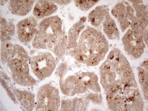 VIP Antibody - Immunohistochemical staining of paraffin-embedded Carcinoma of Human liver tissue using anti-VIP mouse monoclonal antibody. (Heat-induced epitope retrieval by 1mM EDTA in 10mM Tris buffer. (pH8.5) at 120°C for 3 min. (1:150)