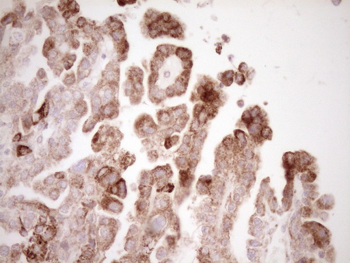 VIP Antibody - Immunohistochemical staining of paraffin-embedded Adenocarcinoma of Human ovary tissue using anti-VIP mouse monoclonal antibody. (Heat-induced epitope retrieval by 1 mM EDTA in 10mM Tris, pH8.5, 120C for 3min,