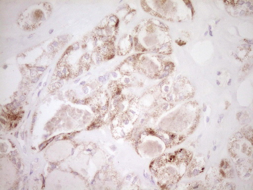 VIP Antibody - Immunohistochemical staining of paraffin-embedded Carcinoma of Human thyroid tissue using anti-VIP mouse monoclonal antibody. (Heat-induced epitope retrieval by 1 mM EDTA in 10mM Tris, pH8.5, 120C for 3min,