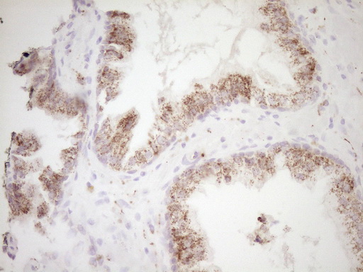 VIP Antibody - Immunohistochemical staining of paraffin-embedded Adenocarcinoma of Human endometrium tissue using anti-VIP mouse monoclonal antibody. (Heat-induced epitope retrieval by 1 mM EDTA in 10mM Tris, pH8.5, 120C for 3min,
