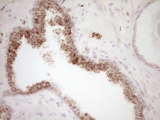 VIP Antibody - Immunohistochemical staining of paraffin-embedded Carcinoma of Human prostate tissue using anti-VIP mouse monoclonal antibody. (Heat-induced epitope retrieval by 1 mM EDTA in 10mM Tris, pH8.5, 120C for 3min,