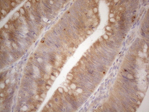 VIP Antibody - Immunohistochemical staining of paraffin-embedded Carcinoma of Human pancreas tissue using anti-VIP mouse monoclonal antibody. (Heat-induced epitope retrieval by 1mM EDTA in 10mM Tris buffer. (pH8.5) at 120°C for 3 min. (1:150)