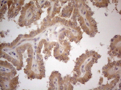 VIP Antibody - Immunohistochemical staining of paraffin-embedded Carcinoma of Human thyroid tissue using anti-VIP mouse monoclonal antibody. (Heat-induced epitope retrieval by 1mM EDTA in 10mM Tris buffer. (pH8.5) at 120°C for 3 min. (1:150)