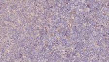 VIPERIN / RSAD2 Antibody - 1:100 staining human lymph carcinoma tissue by IHC-P. The sample was formaldehyde fixed and a heat mediated antigen retrieval step in citrate buffer was performed. The sample was then blocked and incubated with the antibody for 1.5 hours at 22°C. An HRP conjugated goat anti-rabbit antibody was used as the secondary.