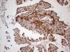 VISA / MAVS Antibody - Immunohistochemical staining of paraffin-embedded Adenocarcinoma of Human ovary tissue using anti-MAVS mouse monoclonal antibody. (Heat-induced epitope retrieval by 1mM EDTA in 10mM Tris buffer. (pH8.5) at 120°C for 3 min. (1:150)