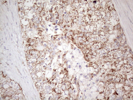 VISA / MAVS Antibody - Immunohistochemical staining of paraffin-embedded Adenocarcinoma of Human endometrium tissue using anti-MAVS mouse monoclonal antibody. (Heat-induced epitope retrieval by 1mM EDTA in 10mM Tris buffer. (pH8.5) at 120°C for 3 min. (1:150)