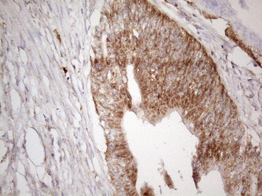 VISA / MAVS Antibody - Immunohistochemical staining of paraffin-embedded Adenocarcinoma of Human colon tissue using anti-MAVS mouse monoclonal antibody. (Heat-induced epitope retrieval by 1mM EDTA in 10mM Tris buffer. (pH8.5) at 120°C for 3 min. (1:150)