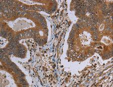 VISA / MAVS Antibody - Immunohistochemistry of paraffin-embedded Human colon cancer using MAVS Polyclonal Antibody at dilution of 1:30.