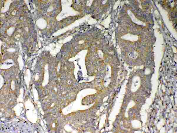 VISA / MAVS Antibody - IHC analysis of MAVS using anti-MAVS antibody. MAVS was detected in paraffin-embedded section of human intestinal cancer tissue. Heat mediated antigen retrieval was performed in citrate buffer (pH6, epitope retrieval solution) for 20 mins. The tissue section was blocked with 10% goat serum. The tissue section was then incubated with 1µg/ml rabbit anti-MAVS Antibody overnight at 4°C. Biotinylated goat anti-rabbit IgG was used as secondary antibody and incubated for 30 minutes at 37°C. The tissue section was developed using Strepavidin-Biotin-Complex (SABC) with DAB as the chromogen.