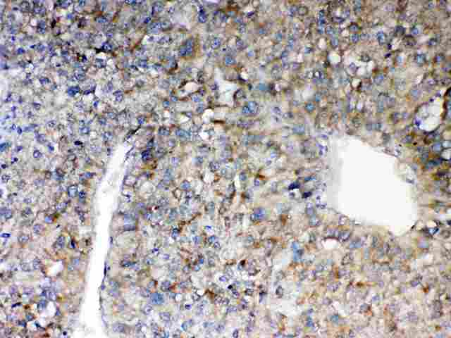 VISA / MAVS Antibody - IHC analysis of MAVS using anti-MAVS antibody. MAVS was detected in paraffin-embedded section of human liver cancer tissue. Heat mediated antigen retrieval was performed in citrate buffer (pH6, epitope retrieval solution) for 20 mins. The tissue section was blocked with 10% goat serum. The tissue section was then incubated with 1µg/ml rabbit anti-MAVS Antibody overnight at 4°C. Biotinylated goat anti-rabbit IgG was used as secondary antibody and incubated for 30 minutes at 37°C. The tissue section was developed using Strepavidin-Biotin-Complex (SABC) with DAB as the chromogen.