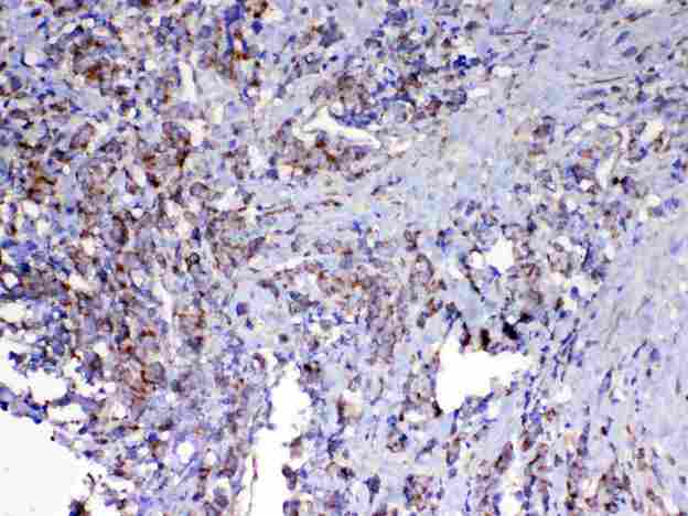 VISA / MAVS Antibody - IHC analysis of MAVS using anti-MAVS antibody. MAVS was detected in paraffin-embedded section of human lung cancer tissue. Heat mediated antigen retrieval was performed in citrate buffer (pH6, epitope retrieval solution) for 20 mins. The tissue section was blocked with 10% goat serum. The tissue section was then incubated with 1µg/ml rabbit anti-MAVS Antibody overnight at 4°C. Biotinylated goat anti-rabbit IgG was used as secondary antibody and incubated for 30 minutes at 37°C. The tissue section was developed using Strepavidin-Biotin-Complex (SABC) with DAB as the chromogen.