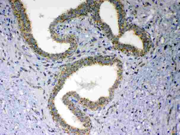 VISA / MAVS Antibody - IHC analysis of MAVS using anti-MAVS antibody. MAVS was detected in paraffin-embedded section of human mammary cancer tissue. Heat mediated antigen retrieval was performed in citrate buffer (pH6, epitope retrieval solution) for 20 mins. The tissue section was blocked with 10% goat serum. The tissue section was then incubated with 1µg/ml rabbit anti-MAVS Antibody overnight at 4°C. Biotinylated goat anti-rabbit IgG was used as secondary antibody and incubated for 30 minutes at 37°C. The tissue section was developed using Strepavidin-Biotin-Complex (SABC) with DAB as the chromogen.