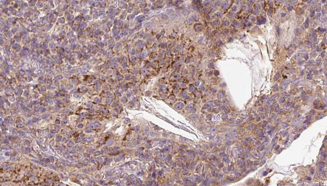 VISA / MAVS Antibody - 1:100 staining human lymph carcinoma tissue by IHC-P. The sample was formaldehyde fixed and a heat mediated antigen retrieval step in citrate buffer was performed. The sample was then blocked and incubated with the antibody for 1.5 hours at 22°C. An HRP conjugated goat anti-rabbit antibody was used as the secondary.