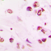 Vitamin D Receptor / VDR Antibody - Immunohistochemical analysis of VDR staining in human lung cancer formalin fixed paraffin embedded tissue section. The section was pre-treated using heat mediated antigen retrieval with sodium citrate buffer (pH 6.0). The section was then incubated with the antibody at room temperature and detected using an HRP conjugated compact polymer system. DAB was used as the chromogen. The section was then counterstained with hematoxylin and mounted with DPX.