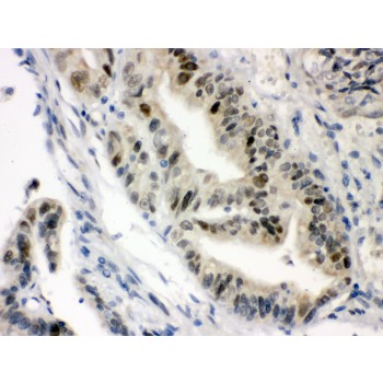 Vitamin D Receptor / VDR Antibody - VDR antibody IHC-paraffin. IHC(P): Human Intestinal Cancer Tissue.