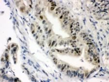 Vitamin D Receptor / VDR Antibody - IHC testing of FFPE human intestine cancer with SLC22A2 antibody. HIER: Boil the paraffin sections in pH 6, 10mM citrate buffer for 20 minutes and allow to cool prior to staining.