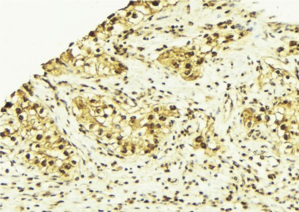 Vitamin D Receptor / VDR Antibody - 1:100 staining human breast carcinoma tissue by IHC-P. The sample was formaldehyde fixed and a heat mediated antigen retrieval step in citrate buffer was performed. The sample was then blocked and incubated with the antibody for 1.5 hours at 22°C. An HRP conjugated goat anti-rabbit antibody was used as the secondary.