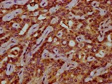 VKORC1 Antibody - Immunohistochemistry Dilution at 1:200 and staining in paraffin-embedded human liver cancer performed on a Leica BondTM system. After dewaxing and hydration, antigen retrieval was mediated by high pressure in a citrate buffer (pH 6.0). Section was blocked with 10% normal Goat serum 30min at RT. Then primary antibody (1% BSA) was incubated at 4°C overnight. The primary is detected by a biotinylated Secondary antibody and visualized using an HRP conjugated SP system.