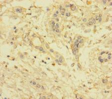 VKORC1L1 Antibody - Immunohistochemistry of paraffin-embedded human pancreatic cancer using VKORC1L1 Antibody at dilution of 1:100