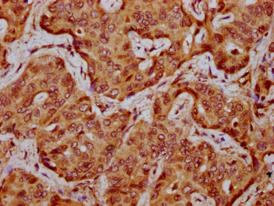 VLDLR Antibody - Immunohistochemistry Dilution at 1:300 and staining in paraffin-embedded human liver cancer performed on a Leica BondTM system. After dewaxing and hydration, antigen retrieval was mediated by high pressure in a citrate buffer (pH 6.0). Section was blocked with 10% normal Goat serum 30min at RT. Then primary antibody (1% BSA) was incubated at 4°C overnight. The primary is detected by a biotinylated Secondary antibody and visualized using an HRP conjugated SP system.