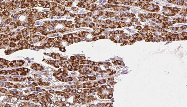 VN1R3 Antibody - 1:100 staining human liver carcinoma tissues by IHC-P. The sample was formaldehyde fixed and a heat mediated antigen retrieval step in citrate buffer was performed. The sample was then blocked and incubated with the antibody for 1.5 hours at 22°C. An HRP conjugated goat anti-rabbit antibody was used as the secondary.