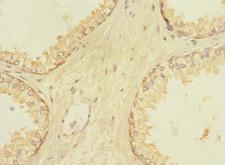 VN1R5 Antibody - Immunohistochemistry of paraffin-embedded human prostate cancer using VN1R5 Antibody at dilution of 1:100