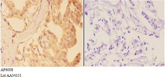 VNN1 Antibody - Immunohistochemistry (IHC) analysis of VNN1 antibody in paraffin-embedded human breast carcinoma tissue at 1:50, showing cytoplasm and membrane staining. Negative control (the right) using PBS instead of primary antibody. Secondary antibody is Goat Anti-Rabbit Ig.