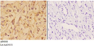 VNN1 Antibody - Immunohistochemistry (IHC) analysis of VNN1 antibody in paraffin-embedded human kidney carcinoma tissue at 1:50, showing cytoplasm and membrane staining. Negative control (the right) using PBS instead of primary antibody. Secondary antibody is Goat Anti-Rabbit Ig.
