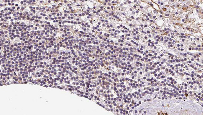 VNN1 Antibody - 1:100 staining human lymph carcinoma tissue by IHC-P. The sample was formaldehyde fixed and a heat mediated antigen retrieval step in citrate buffer was performed. The sample was then blocked and incubated with the antibody for 1.5 hours at 22°C. An HRP conjugated goat anti-rabbit antibody was used as the secondary.