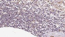 VNN1 Antibody - 1:100 staining human lymph carcinoma tissue by IHC-P. The sample was formaldehyde fixed and a heat mediated antigen retrieval step in citrate buffer was performed. The sample was then blocked and incubated with the antibody for 1.5 hours at 22°C. An HRP conjugated goat anti-rabbit antibody was used as the secondary.