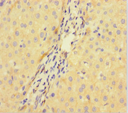 VPRBP Antibody - Immunohistochemistry of paraffin-embedded human liver cancer at dilution of 1:100
