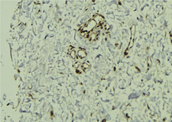 VPRBP Antibody - 1:100 staining human breast carcinoma tissue by IHC-P. The sample was formaldehyde fixed and a heat mediated antigen retrieval step in citrate buffer was performed. The sample was then blocked and incubated with the antibody for 1.5 hours at 22°C. An HRP conjugated goat anti-rabbit antibody was used as the secondary.