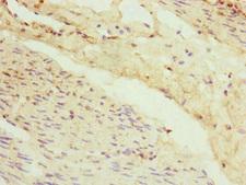 VPS11 Antibody - Immunohistochemistry of paraffin-embedded human bladder cancer at dilution of 1:100