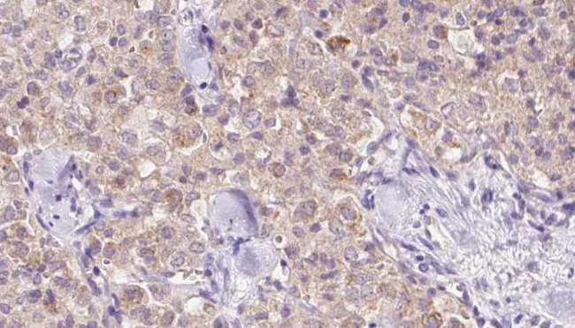 VPS11 Antibody - 1:100 staining human thyroid carcinoma tissue by IHC-P. The sample was formaldehyde fixed and a heat mediated antigen retrieval step in citrate buffer was performed. The sample was then blocked and incubated with the antibody for 1.5 hours at 22°C. An HRP conjugated goat anti-rabbit antibody was used as the secondary.