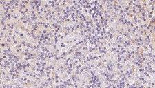 VPS16 Antibody - 1:100 staining human lymph carcinoma tissue by IHC-P. The sample was formaldehyde fixed and a heat mediated antigen retrieval step in citrate buffer was performed. The sample was then blocked and incubated with the antibody for 1.5 hours at 22°C. An HRP conjugated goat anti-rabbit antibody was used as the secondary.