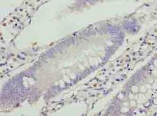 VPS25 Antibody - Immunohistochemistry of paraffin-embedded human colon cancer using antibody at dilution of 1:100.