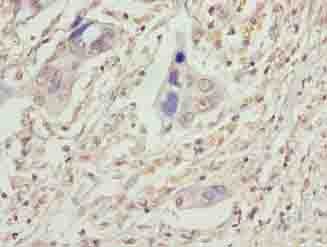 VPS25 Antibody - Immunohistochemistry of paraffin-embedded human pancreatic cancer using antibody at dilution of 1:100.