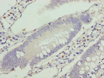 VPS25 Antibody - Immunohistochemistry of paraffin-embedded human colon cancer using VPS25 Antibody at dilution of 1:100