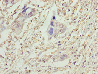 VPS25 Antibody - Immunohistochemistry of paraffin-embedded human pancreatic cancer using VPS25 Antibody at dilution of 1:100