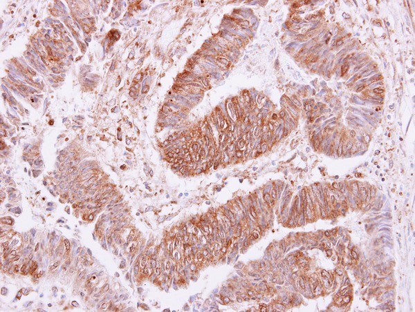 VPS35 Antibody - VPS35 antibody [C3], C-term detects VPS35 protein at cytoplasm and membrane on colon carcinoma by immunohistochemical analysis. Sample: Paraffin-embedded colon carcinoma. VPS35 antibody [C3], C-term dilution:1:250.