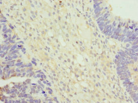 VPS35 Antibody - Immunohistochemistry of paraffin-embedded human ovarian cancer at dilution 1:100