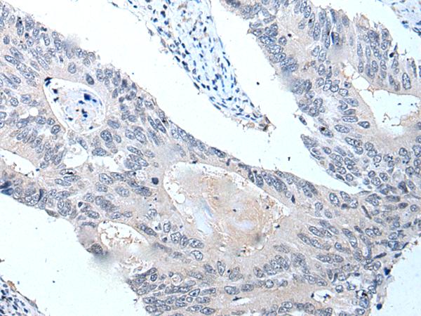 VPS35 Antibody - Immunohistochemistry of paraffin-embedded Human colorectal cancer tissue  using VPS35 Polyclonal Antibody at dilution of 1:25(×200)