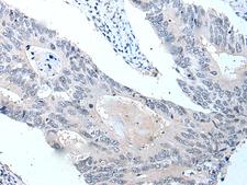 VPS35 Antibody - Immunohistochemistry of paraffin-embedded Human colorectal cancer tissue  using VPS35 Polyclonal Antibody at dilution of 1:25(×200)