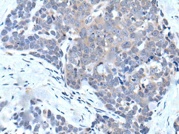 VPS35 Antibody - Immunohistochemistry of paraffin-embedded Human thyroid cancer tissue  using VPS35 Polyclonal Antibody at dilution of 1:25(×200)