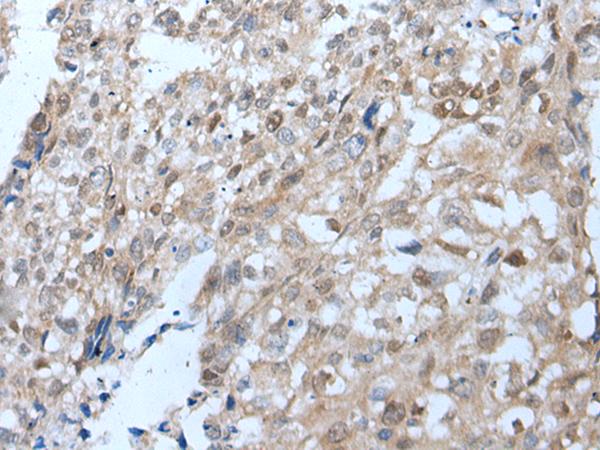 VPS35 Antibody - Immunohistochemistry of paraffin-embedded Human lung cancer tissue  using VPS35 Polyclonal Antibody at dilution of 1:25(×200)