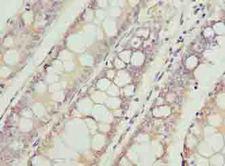 VPS45 Antibody - Immunohistochemistry of paraffin-embedded human colon cancer using antibody at dilution of 1:100.