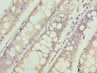 VPS45 Antibody - Immunohistochemistry of paraffin-embedded human colon cancer using VPS45 Antibody at dilution of 1:100